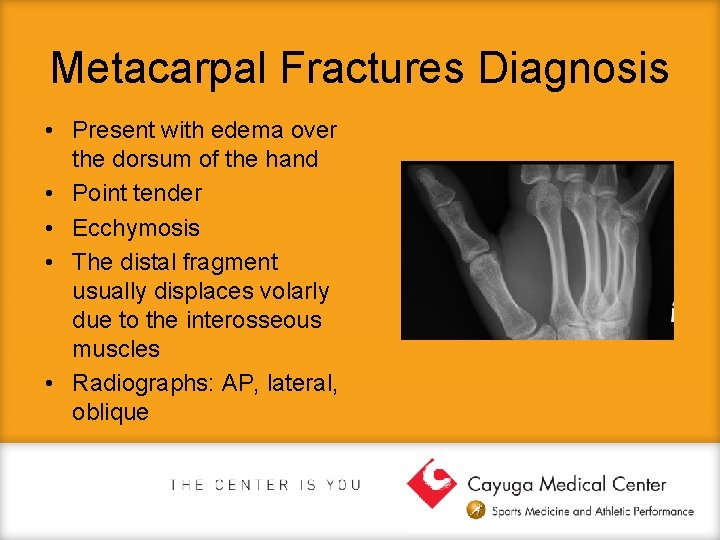 Metacarpal Fractures Diagnosis • Present with edema over the dorsum of the hand •