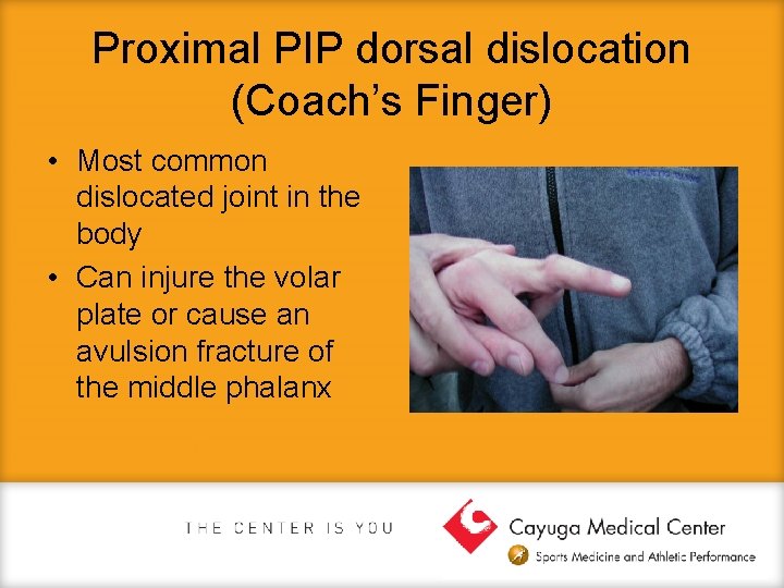 Proximal PIP dorsal dislocation (Coach’s Finger) • Most common dislocated joint in the body