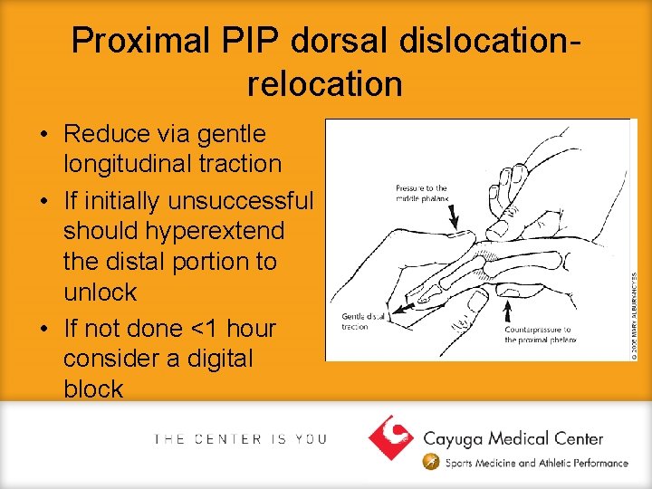 Proximal PIP dorsal dislocationrelocation • Reduce via gentle longitudinal traction • If initially unsuccessful