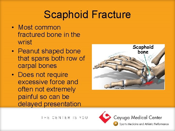 Scaphoid Fracture • Most common fractured bone in the wrist • Peanut shaped bone