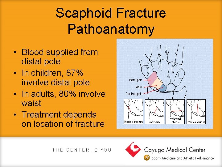 Scaphoid Fracture Pathoanatomy • Blood supplied from distal pole • In children, 87% involve