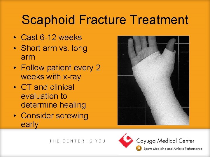 Scaphoid Fracture Treatment • Cast 6 -12 weeks • Short arm vs. long arm