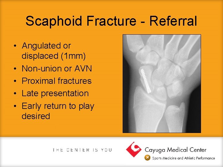 Scaphoid Fracture - Referral • Angulated or displaced (1 mm) • Non-union or AVN