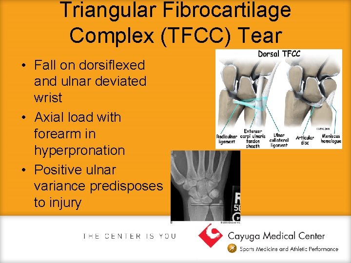 Triangular Fibrocartilage Complex (TFCC) Tear • Fall on dorsiflexed and ulnar deviated wrist •