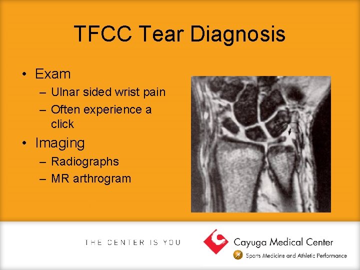 TFCC Tear Diagnosis • Exam – Ulnar sided wrist pain – Often experience a