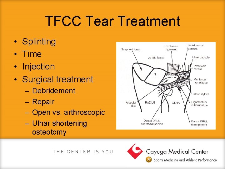 TFCC Tear Treatment • • Splinting Time Injection Surgical treatment – – Debridement Repair
