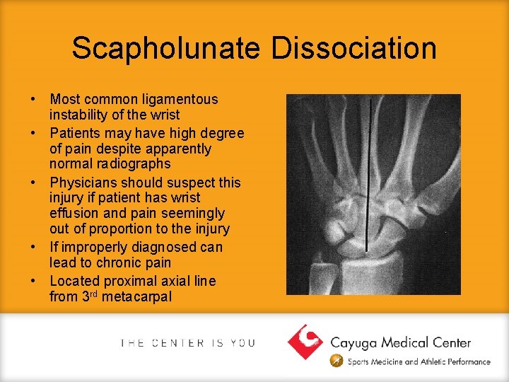 Scapholunate Dissociation • Most common ligamentous instability of the wrist • Patients may have