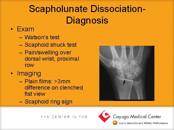 Scapholunate Dissociation. Diagnosis • Exam – Watson’s test – Scaphoid shuck test – Pain/swelling