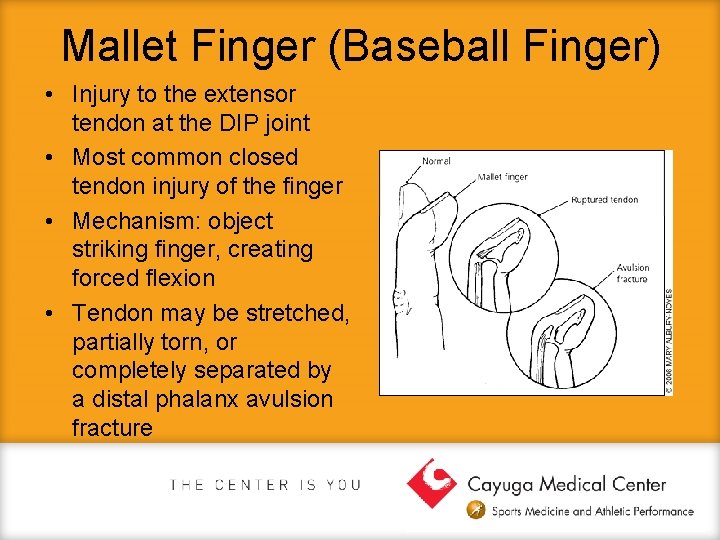 Mallet Finger (Baseball Finger) • Injury to the extensor tendon at the DIP joint