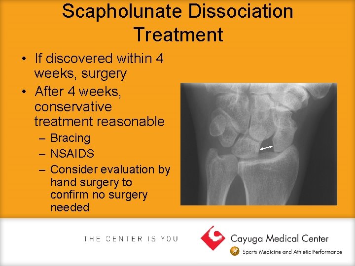 Scapholunate Dissociation Treatment • If discovered within 4 weeks, surgery • After 4 weeks,