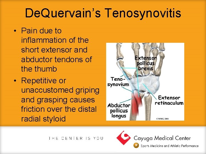De. Quervain’s Tenosynovitis • Pain due to inflammation of the short extensor and abductor