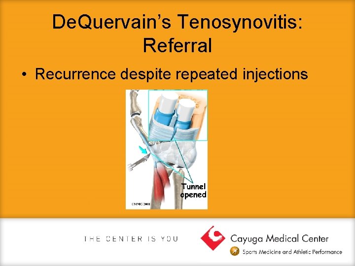 De. Quervain’s Tenosynovitis: Referral • Recurrence despite repeated injections 