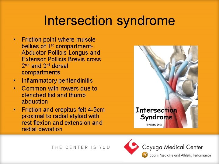 Intersection syndrome • Friction point where muscle bellies of 1 st compartment. Abductor Pollicis