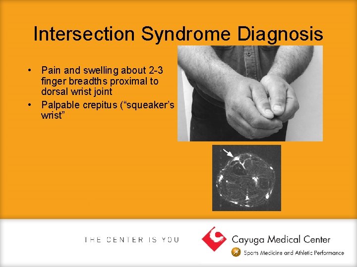 Intersection Syndrome Diagnosis • Pain and swelling about 2 -3 finger breadths proximal to