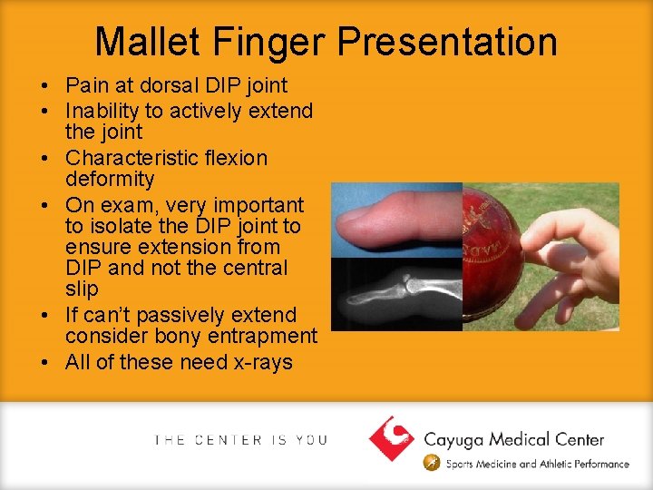 Mallet Finger Presentation • Pain at dorsal DIP joint • Inability to actively extend
