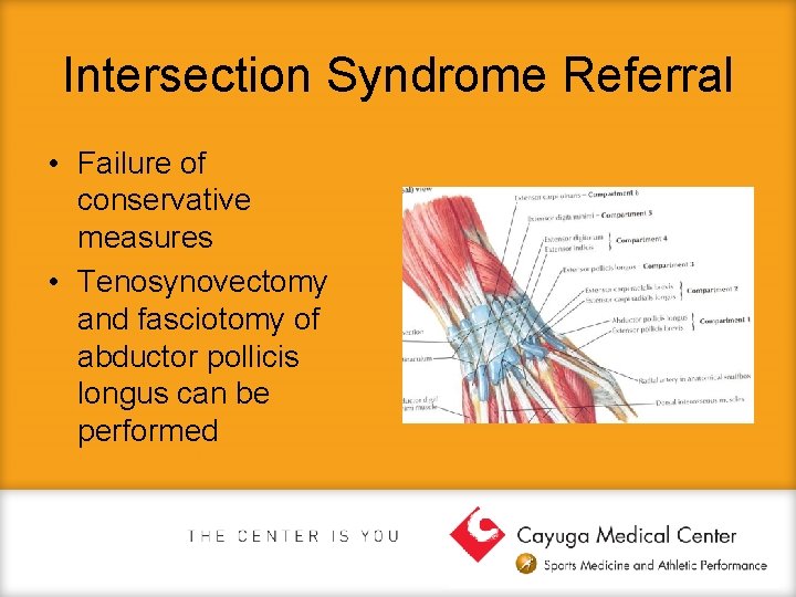 Intersection Syndrome Referral • Failure of conservative measures • Tenosynovectomy and fasciotomy of abductor
