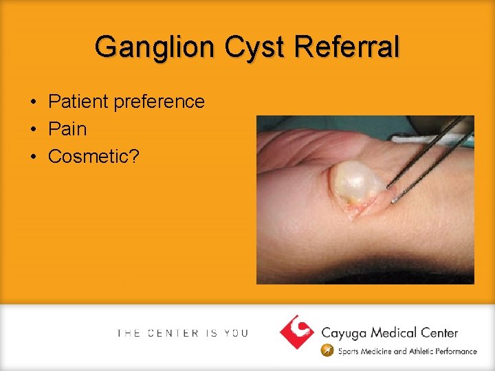 Ganglion Cyst Referral • Patient preference • Pain • Cosmetic? 