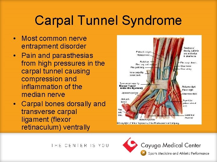 Carpal Tunnel Syndrome • Most common nerve entrapment disorder • Pain and parasthesias from