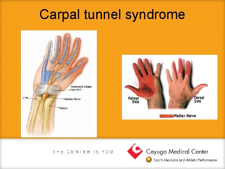 Carpal tunnel syndrome 