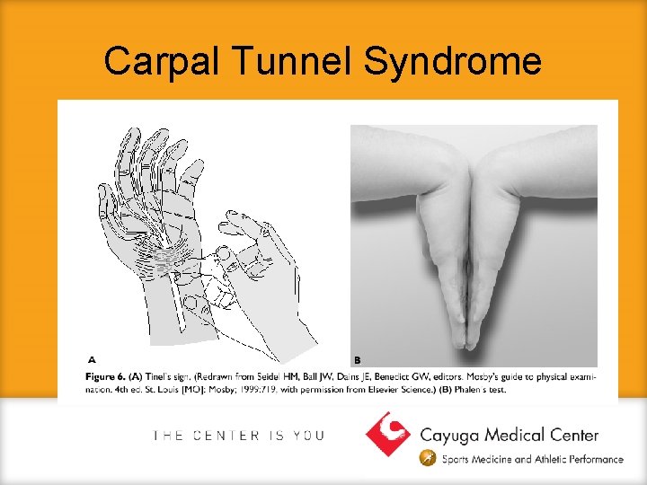 Carpal Tunnel Syndrome 