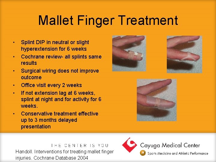 Mallet Finger Treatment • • • Splint DIP in neutral or slight hyperextension for