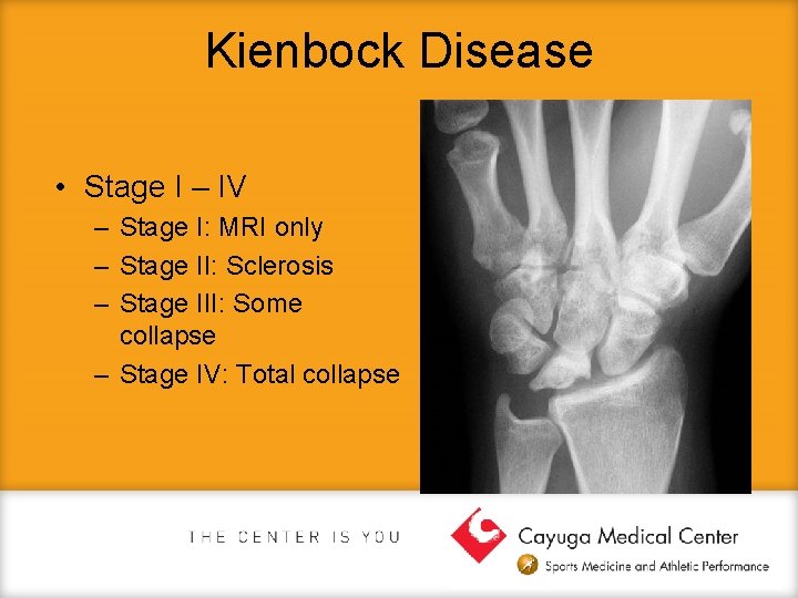 Kienbock Disease • Stage I – IV – Stage I: MRI only – Stage