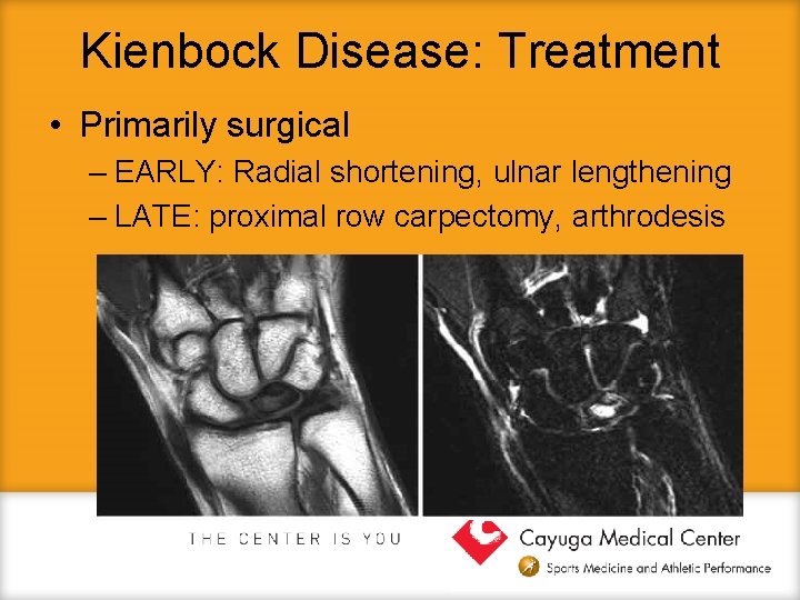 Kienbock Disease: Treatment • Primarily surgical – EARLY: Radial shortening, ulnar lengthening – LATE: