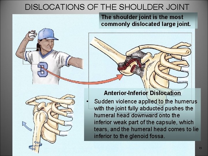 DISLOCATIONS OF THE SHOULDER JOINT The shoulder joint is the most commonly dislocated large
