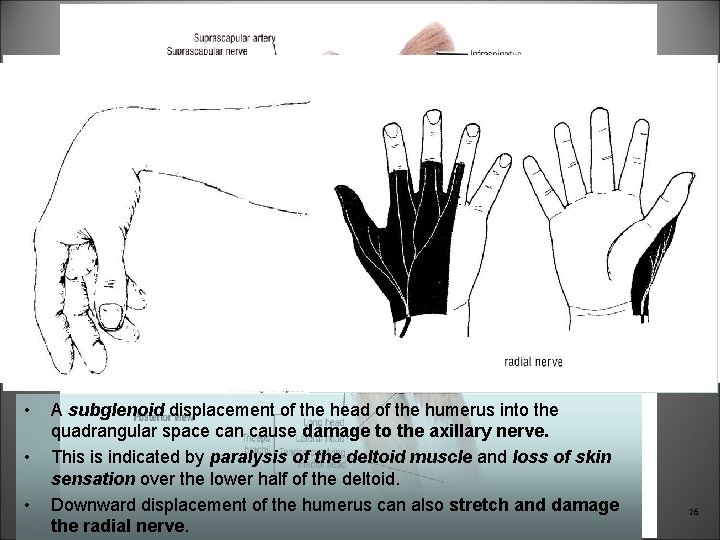 Wrist drop • • • A subglenoid displacement of the head of the humerus