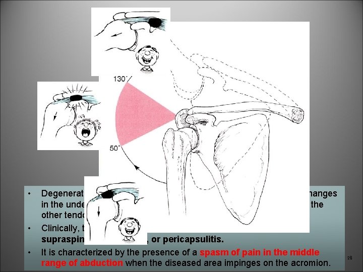  • • • Degenerative changes in the bursa are followed by degenerative changes