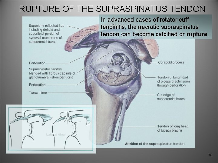 RUPTURE OF THE SUPRASPINATUS TENDON In advanced cases of rotator cuff tendinitis, the necrotic