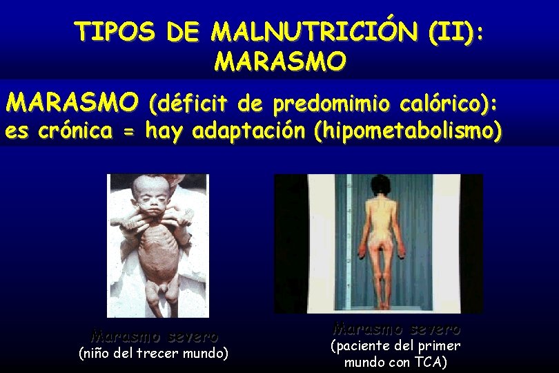 TIPOS DE MALNUTRICIÓN (II): MARASMO (déficit de predomimio calórico): es crónica = hay adaptación