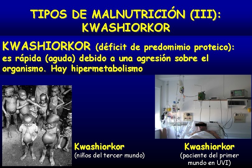 TIPOS DE MALNUTRICIÓN (III): KWASHIORKOR (déficit de predomimio proteico): es rápida (aguda) debido a