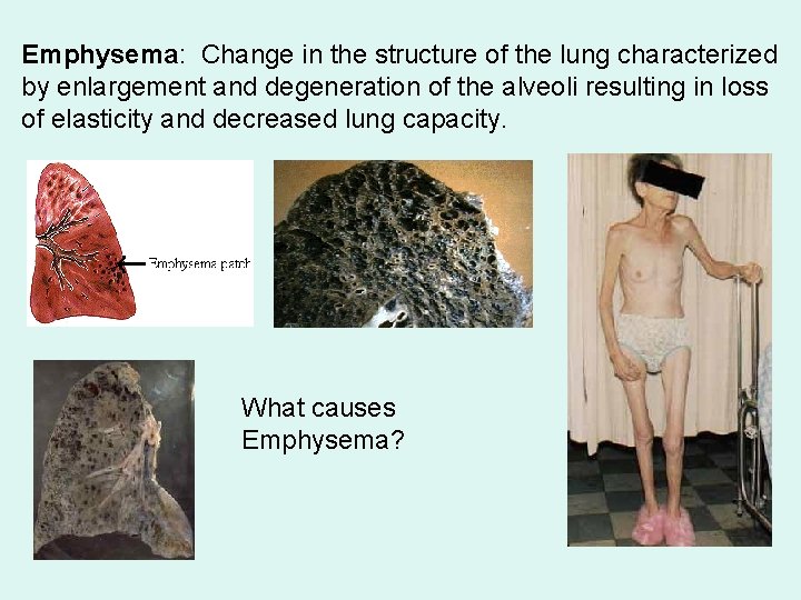 Emphysema: Change in the structure of the lung characterized by enlargement and degeneration of