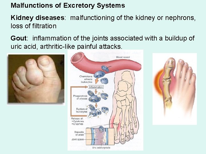 Malfunctions of Excretory Systems Kidney diseases: malfunctioning of the kidney or nephrons, loss of