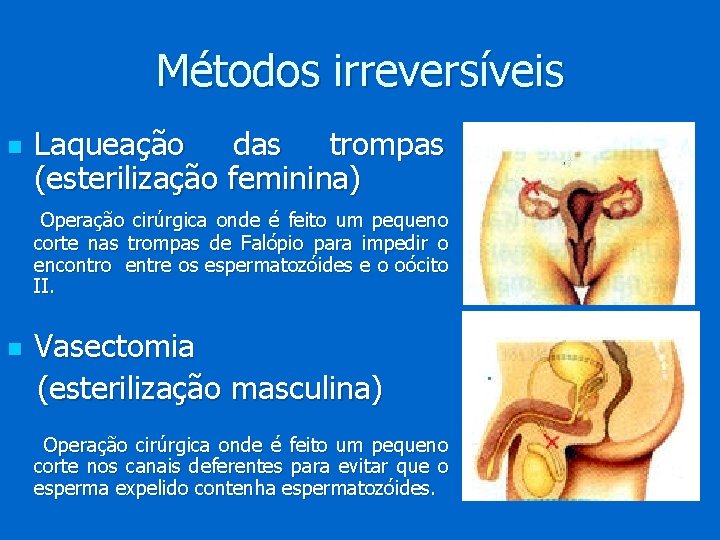Métodos irreversíveis n Laqueação das trompas (esterilização feminina) Operação cirúrgica onde é feito um
