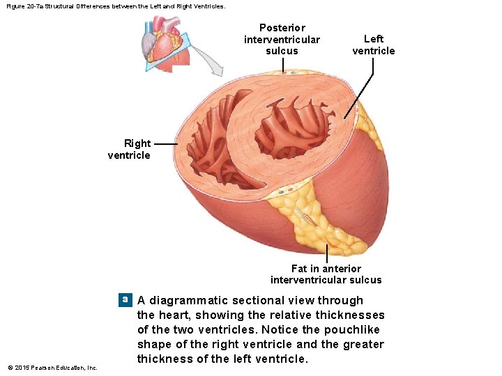 Figure 20 -7 a Structural Differences between the Left and Right Ventricles. Posterior interventricular