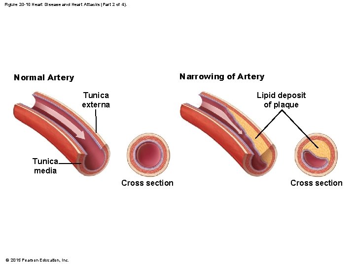 Figure 20 -10 Heart Disease and Heart Attacks (Part 2 of 4). Narrowing of