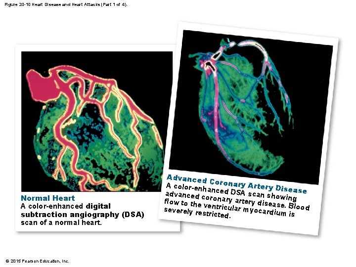 Figure 20 -10 Heart Disease and Heart Attacks (Part 1 of 4). Normal Heart