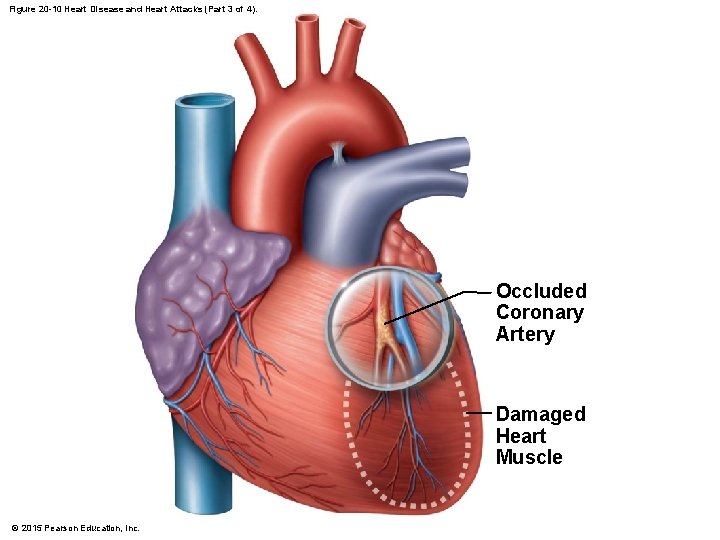 Figure 20 -10 Heart Disease and Heart Attacks (Part 3 of 4). Occluded Coronary