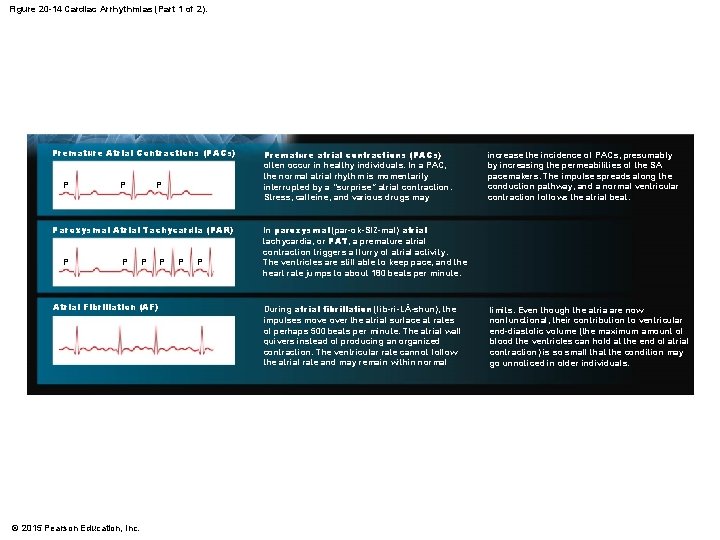 Figure 20 -14 Cardiac Arrhythmias (Part 1 of 2). Premature Atrial Contractions (PACs) P