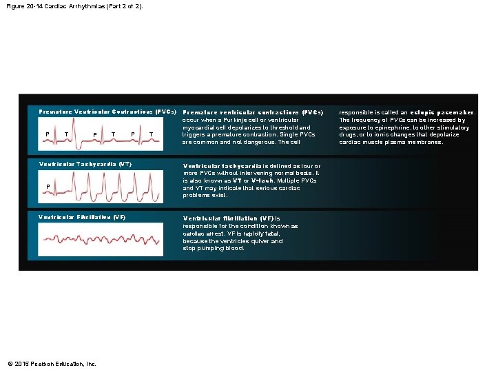 Figure 20 -14 Cardiac Arrhythmias (Part 2 of 2). Premature Ventricular Contractions (PVCs) P