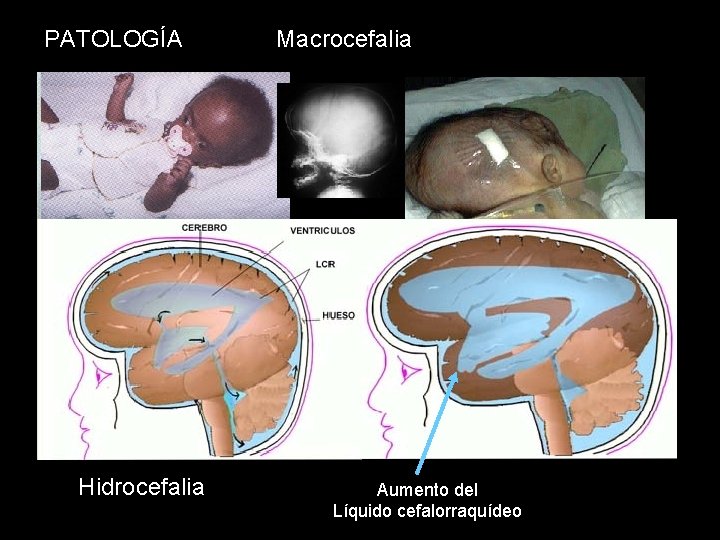 PATOLOGÍA Hidrocefalia Macrocefalia Aumento del Líquido cefalorraquídeo 