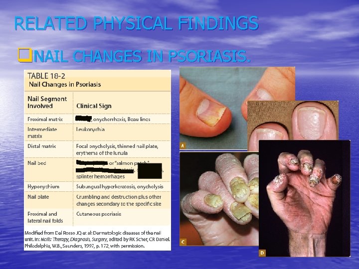 RELATED PHYSICAL FINDINGS q. NAIL CHANGES IN PSORIASIS. 