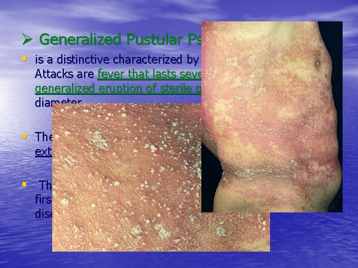 Ø Generalized Pustular Psoriasis § is a distinctive characterized by acute variant of psoriasis.