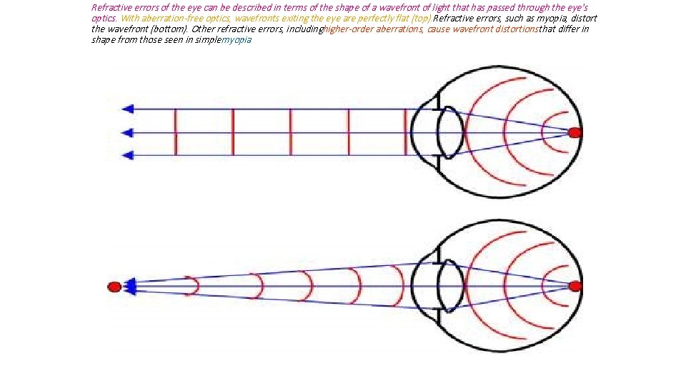 Refractive errors of the eye can be described in terms of the shape of