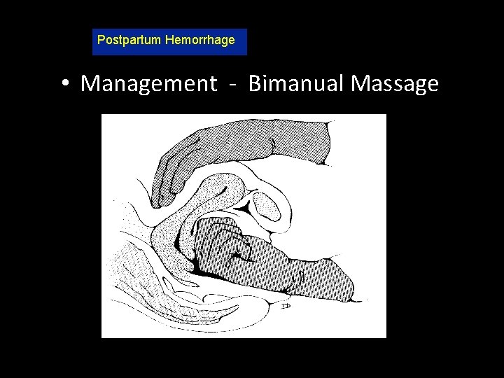 Postpartum Hemorrhage • Management - Bimanual Massage 