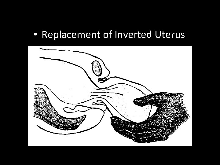  • Replacement of Inverted Uterus 