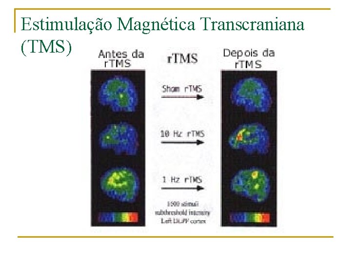 Estimulação Magnética Transcraniana (TMS) 