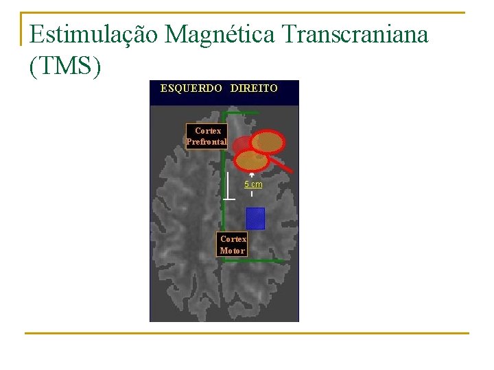 Estimulação Magnética Transcraniana (TMS) 